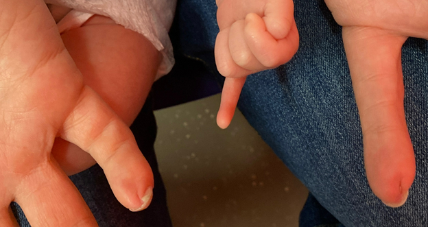 UMS child and parent; left hand with fifth finger contracture.