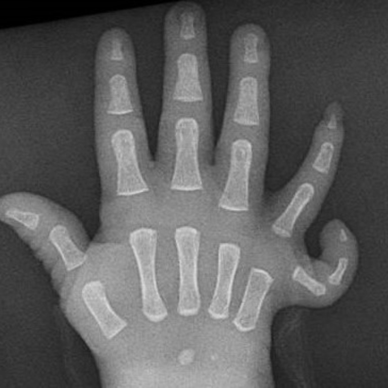 X-ray image of a pediatric right hand affected by UMS