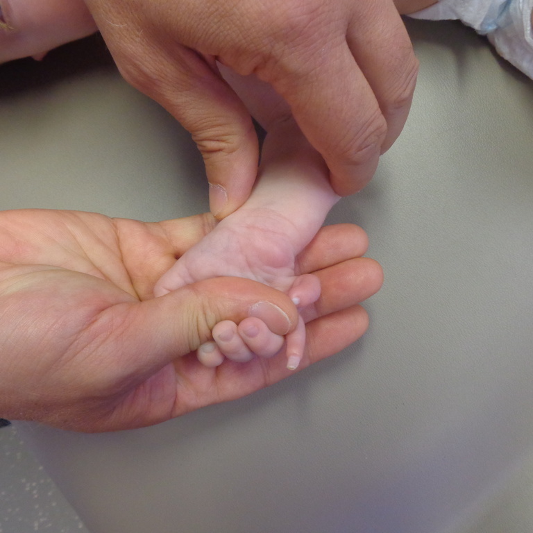 Right hand of child with UMS showing sixth digit and duplicated nail.