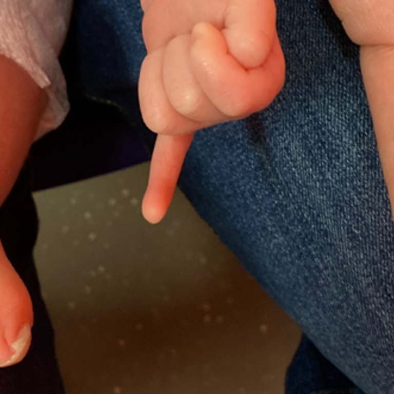 UMS child and parent; left hand with fifth finger contracture.